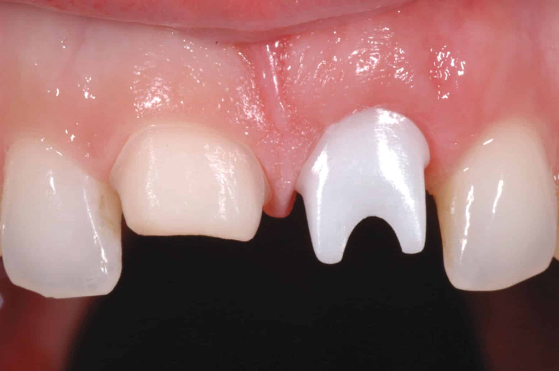 CAD-CAM-Customized-Zirconia-Abutments encode empowered laboratory EEL image