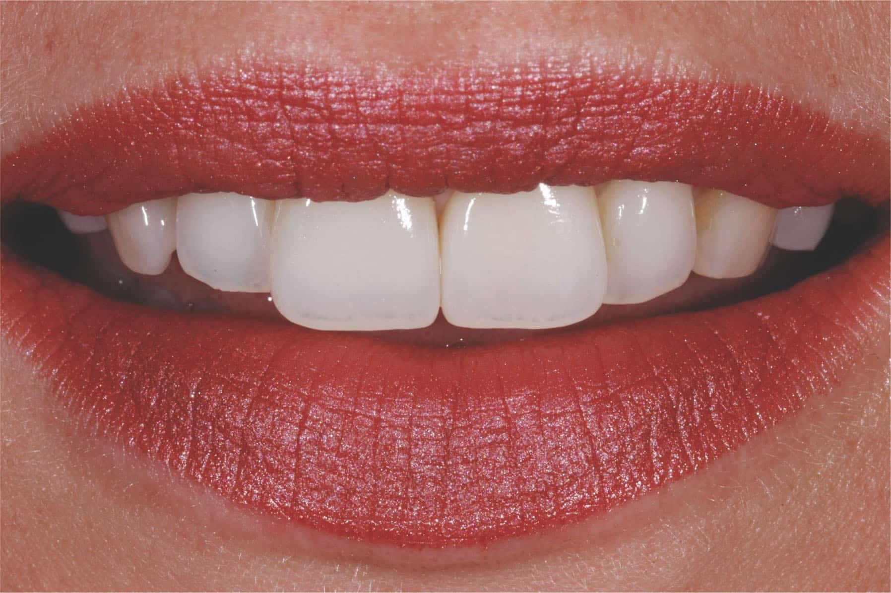 implant dental image
