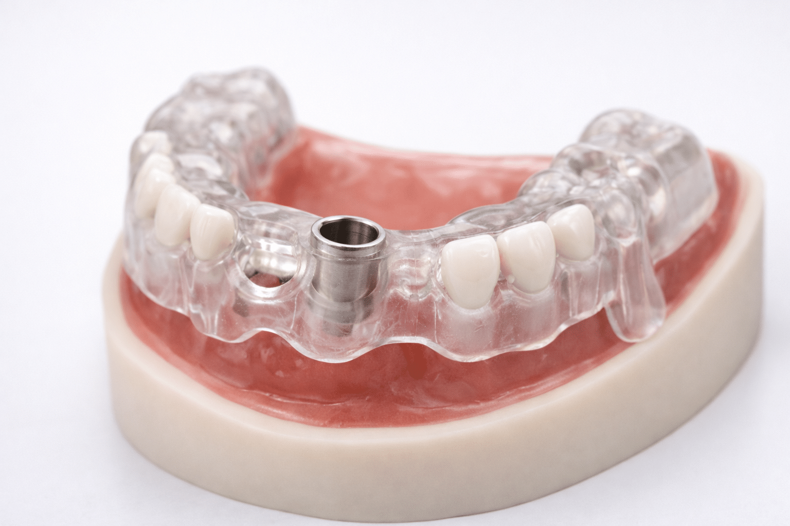 Dental implant surgical guide with metal sleeve on dental model